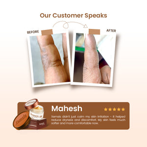 Before and after comparison of skin irritation with Xermis psoriasis cream, featuring a customer review from Mahesh.