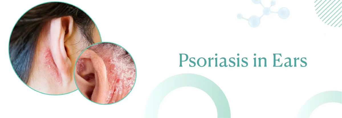 Psoriasis in the Ears