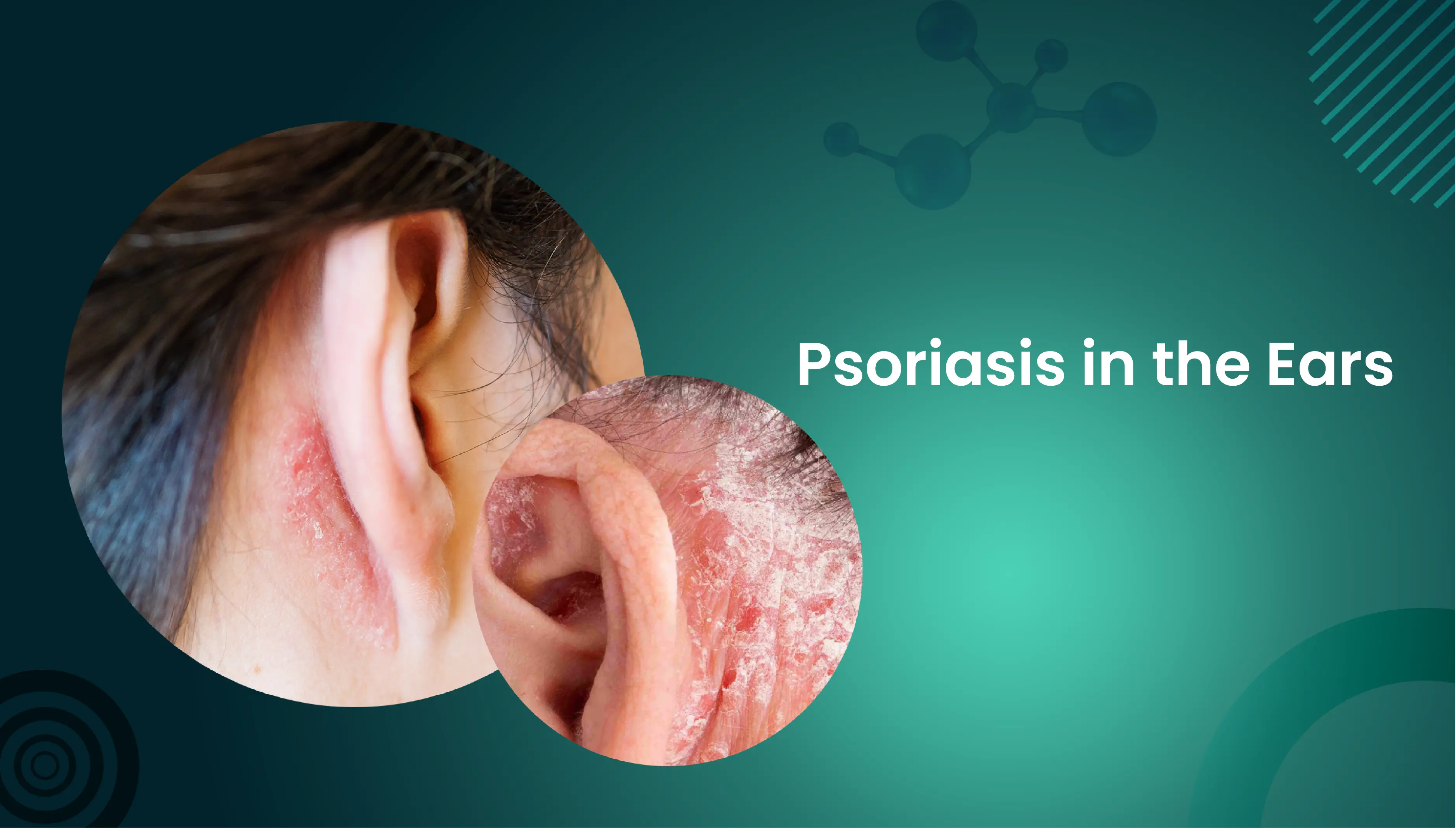 Psoriasis in the Ears