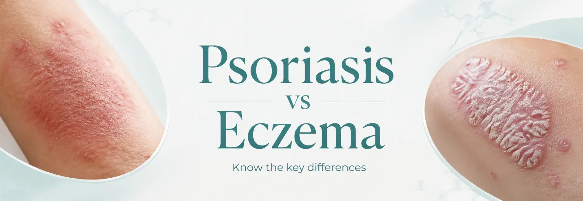 Psoriasis vs. Eczema : How to Know the Difference